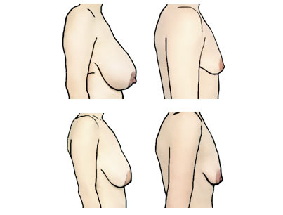 Know Your Breasts: Guide to Classifying Your Breast Position