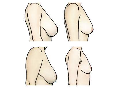 How the Placement of Your Breasts Impacts What You Wear — Inside