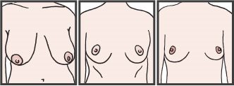 What are Splayed Breasts?