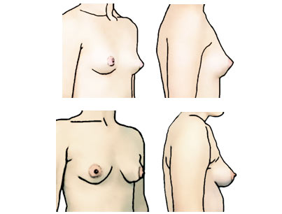 Classify Your Breasts: Breast Shape. Expert Bra Fitting Advice by