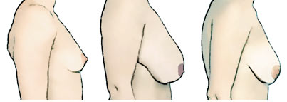 Classify Your Breasts: Upper Breast Fullness. Expert Bra Fitting Advice by  Tomima Edmark